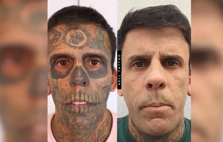 Tumor na Bexiga Ocupa Um Terço do Órgão de Homem Mais Tatuado do Brasil